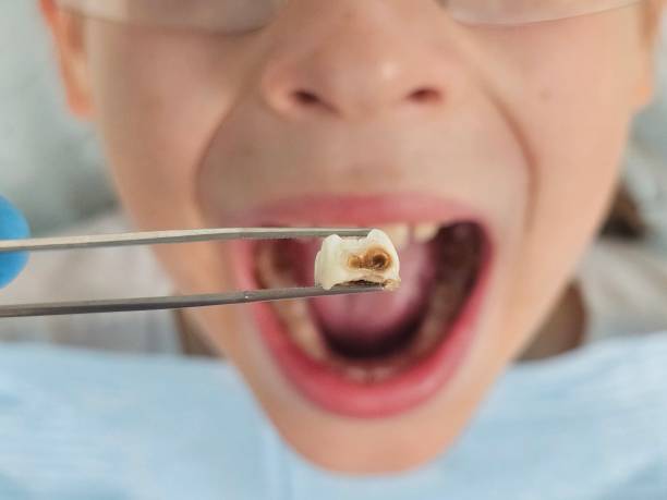 Best Emergency Dentist for Knocked-Out Tooth in Gretna, VA